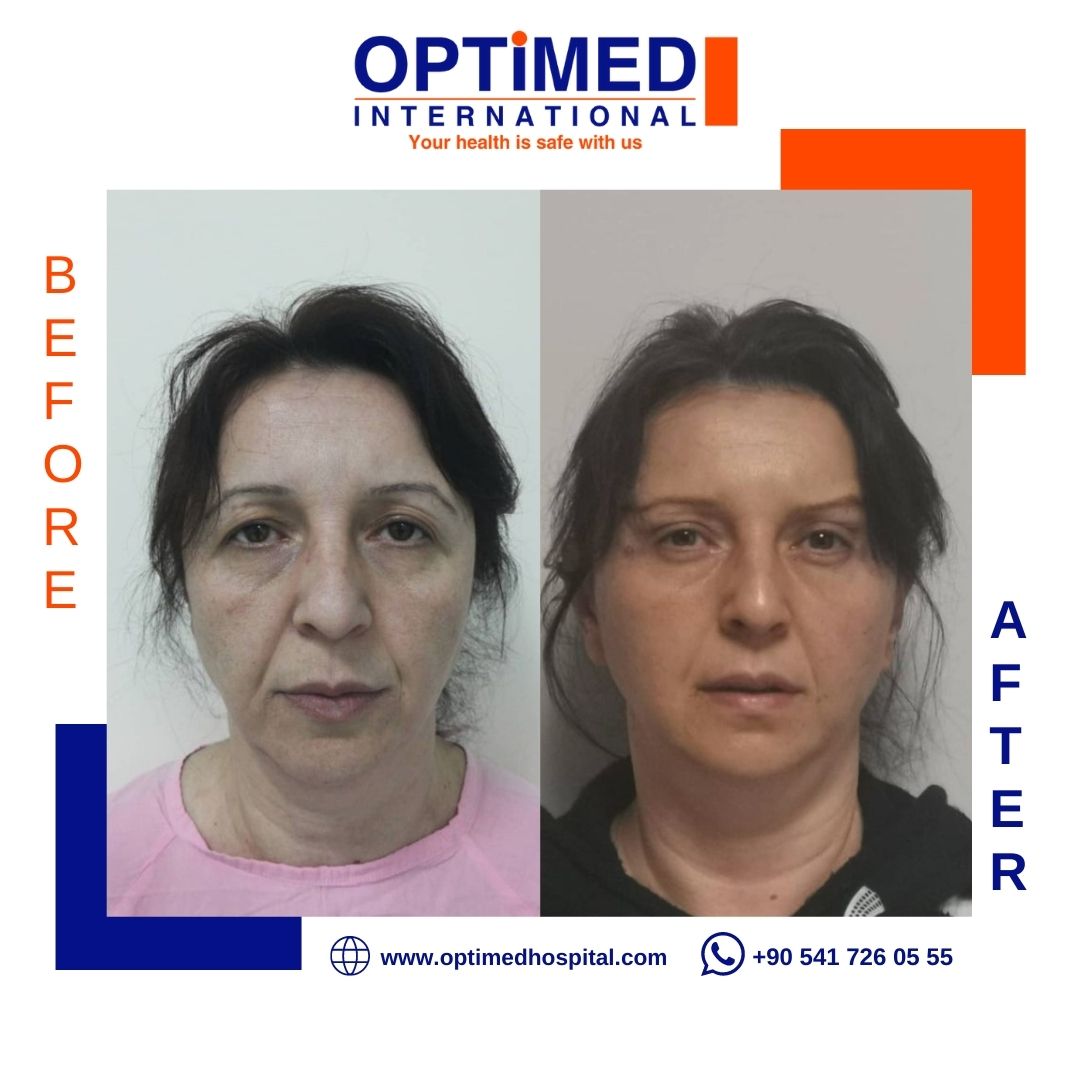 Estetică facială — sonuç 9