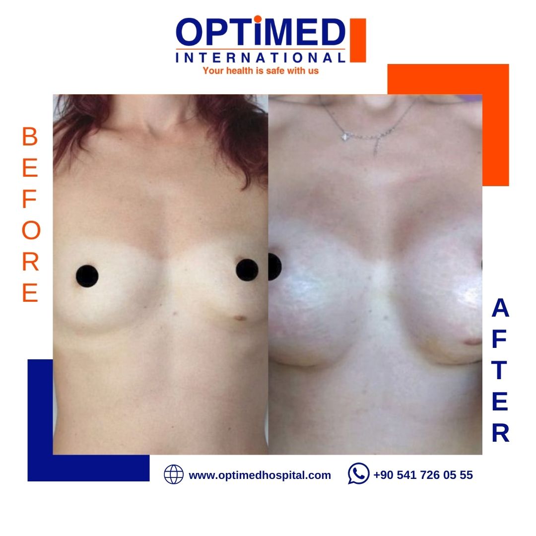 Estetică mamară — sonuç 1