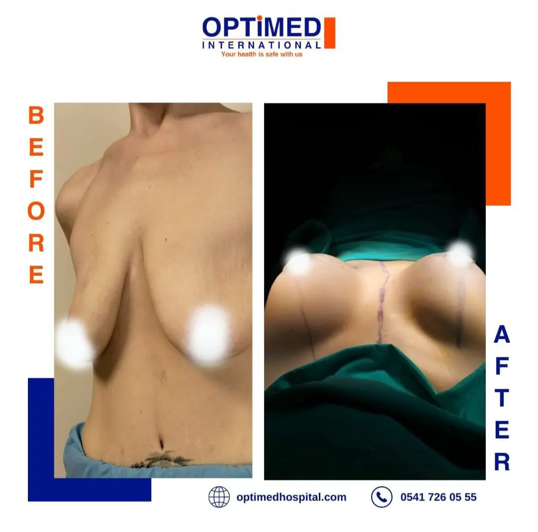 Estetică mamară — sonuç 2