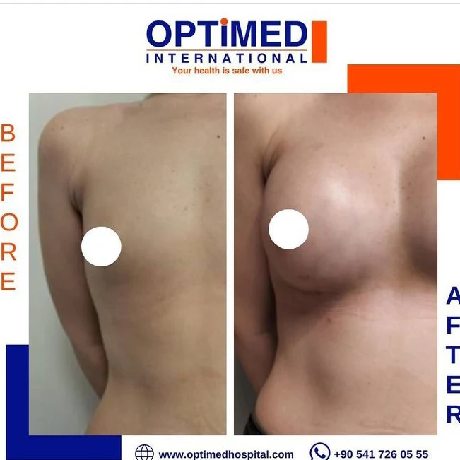 Estetică mamară — sonuç 3